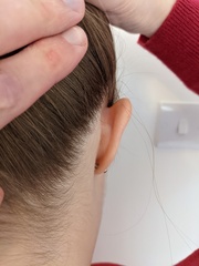 Lump on bone behind my ear