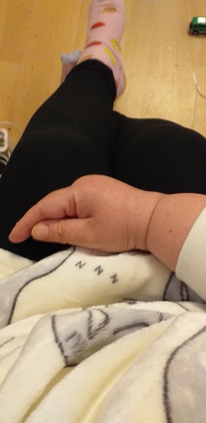 Edema for over 6 months. Dr seemingly disinterested