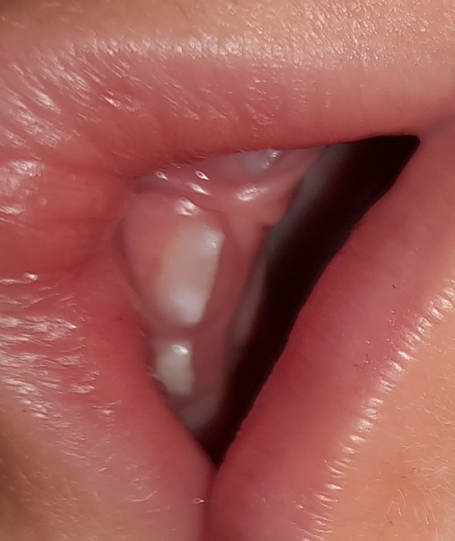 Baby's teeth damaged already?!