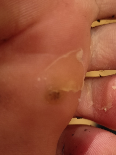 What's this on the bottom of my foot