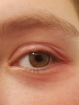 Urgh, Acnecide on eyelids