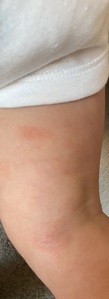 Toddler skin