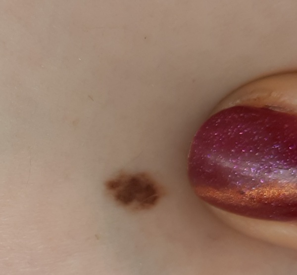 Worried about mole- anyone know anything about skin moles?