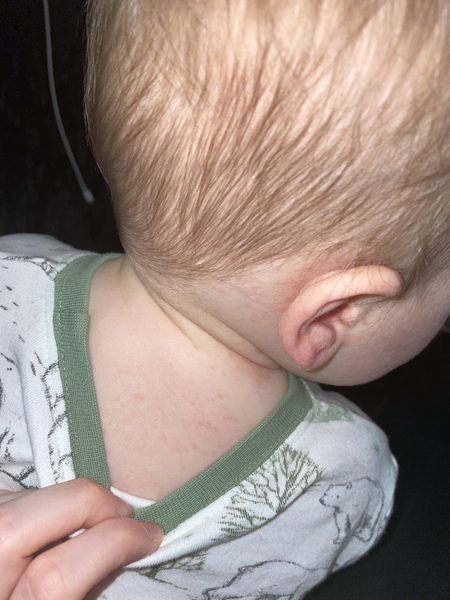 Rash Advice