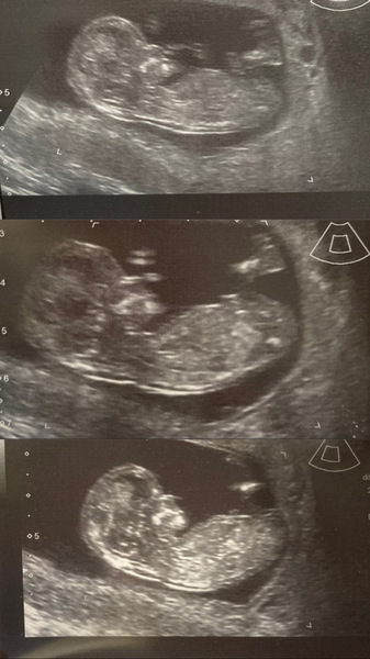 Nub theory.. Girl or Boy!?