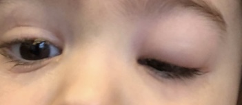 Peri orbital cellulitis