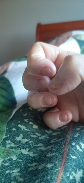 Can't overcome decades-long severe nail-biting: help