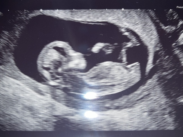 Any guesses? Boy or girl. 12 week scan