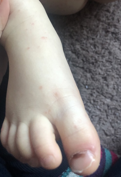 Can chickenpox mainly be in the nappy area & nowhere else?