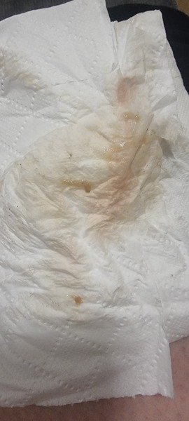 Implantation bleed?