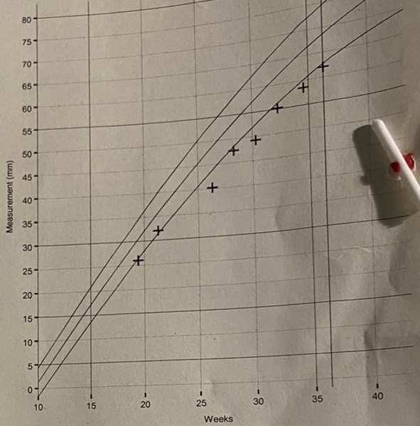 Short femur and humerus