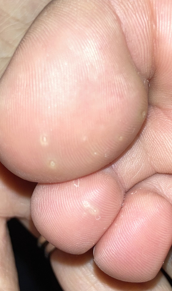 Cluster of veruccas? Pic included