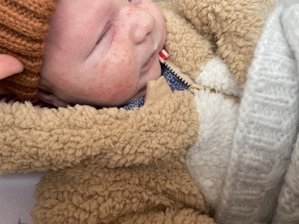 Red spots / rash on 4 week olds face