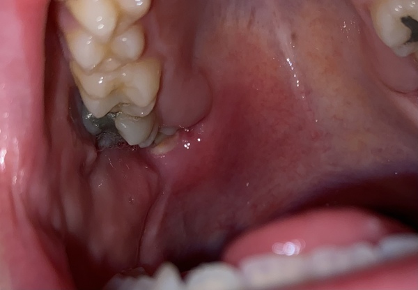 In agony - pericoronitis