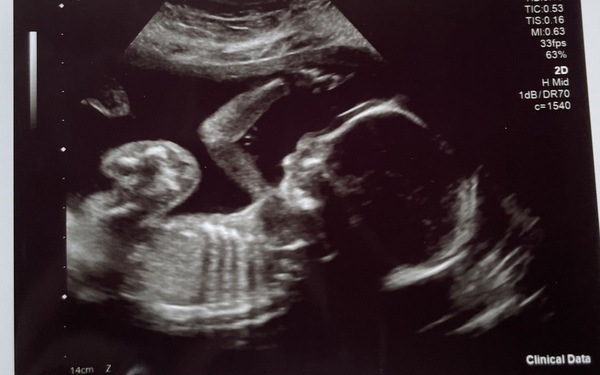 Pregnancy anxiety over scan picture.