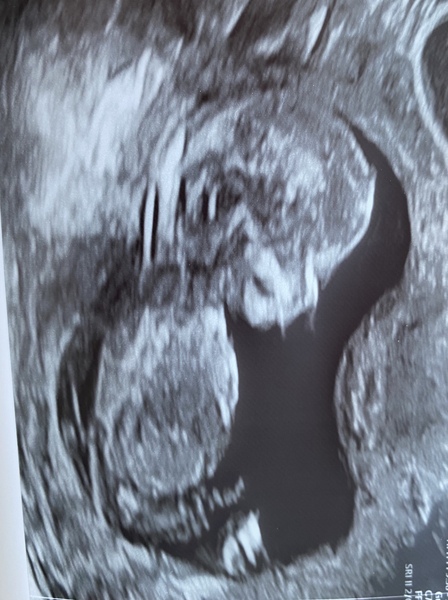 Gender Guess? Boy or girl??💕💙