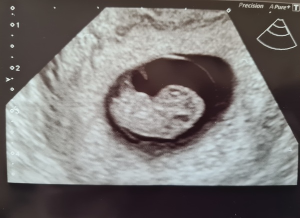 Crippled with anxiety that it might be twins again *TRIGGER WARNING*