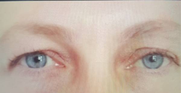 Eye lid surgery