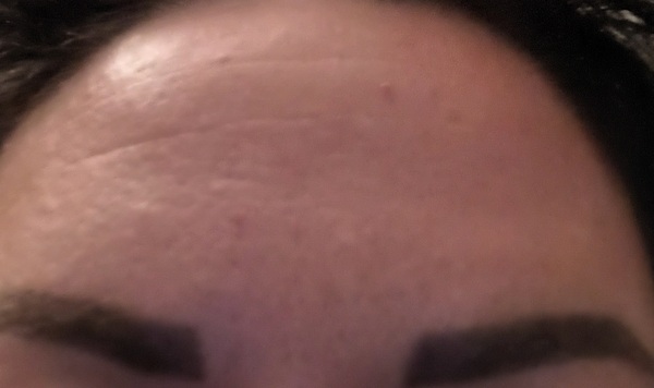 Would you think botox is worth getting (photo)
