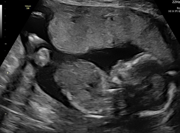 Due June 2022 (thread six)