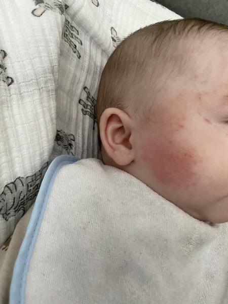 Is this just baby eczema? (Pic included)