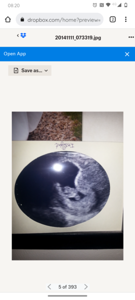 7 week ultrasound, twins or single & sack?