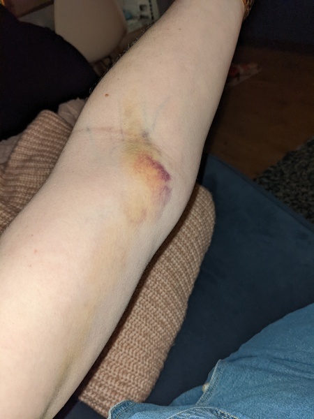 Where did this bruise come from?