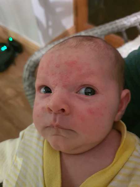 Baby acne?! Advice