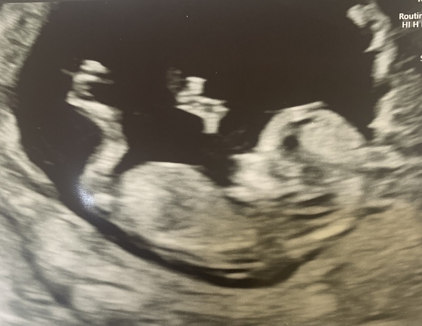 12w3d scan photo boy or girl?