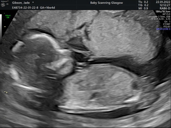 16w4d scan