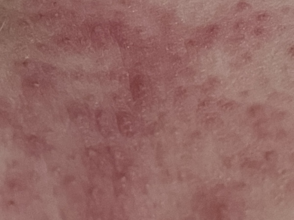 Rash between boobs (TMI photo). Help before I claw them off .