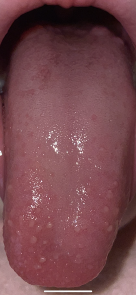 DD bumps on tongue