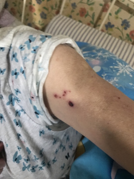My Mum & her bites