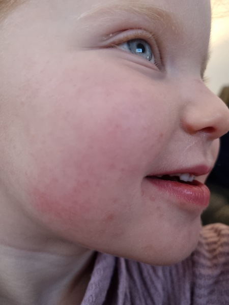 Bed bug rashes