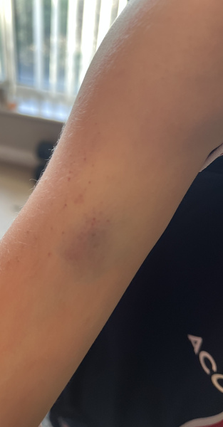 Skin rash and unexplained bruising after COVID. Is this a thing??
