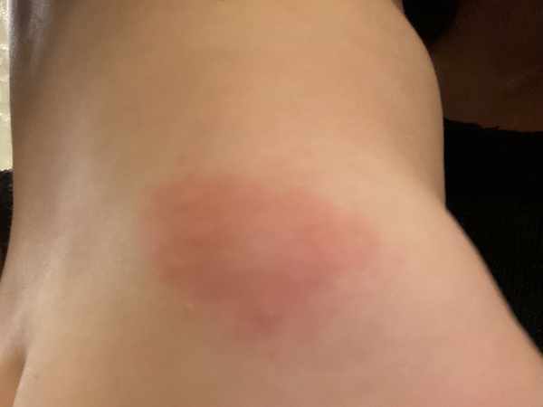 Any idea what this very specifically formed rash is from?!