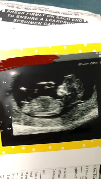 Nub theory- boy or girl?