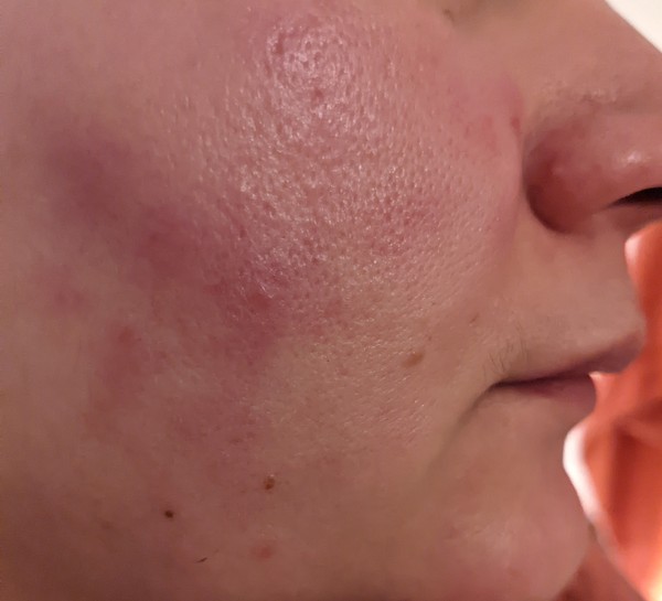 What is going on with my skin (and how do I stop it)?