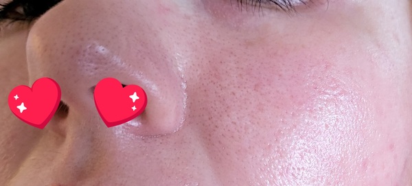 Giant, Humungous pores!!!!!