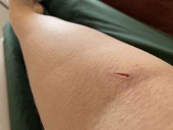 Routine blood test injury