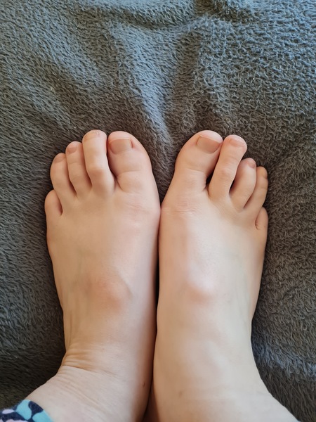 Foot surgery