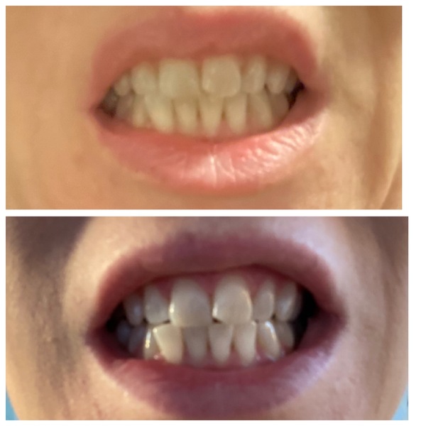I’m having my teeth professionally whitened this week