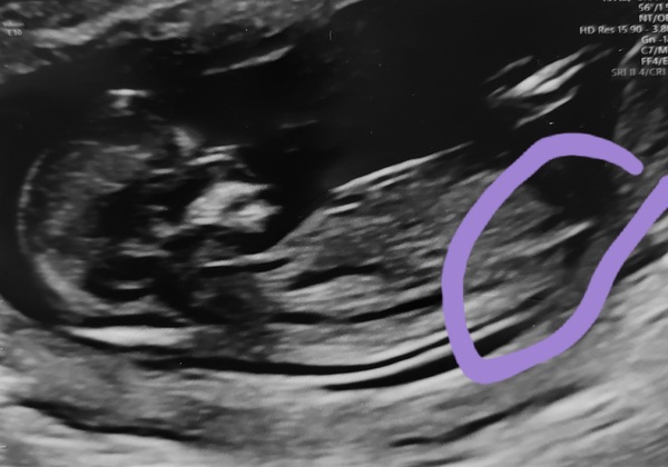 Is this a nub?