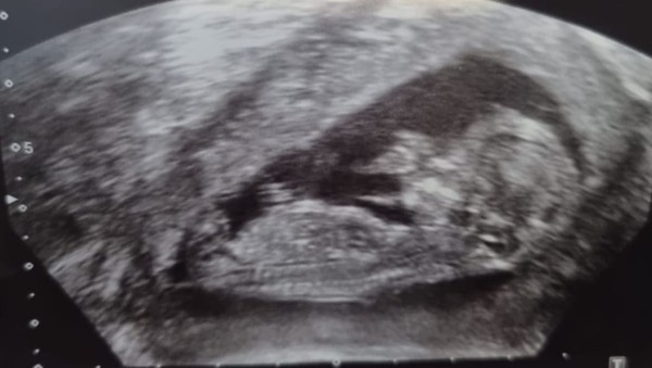 13 week scan - can anyone see a nub?? (just for fun)