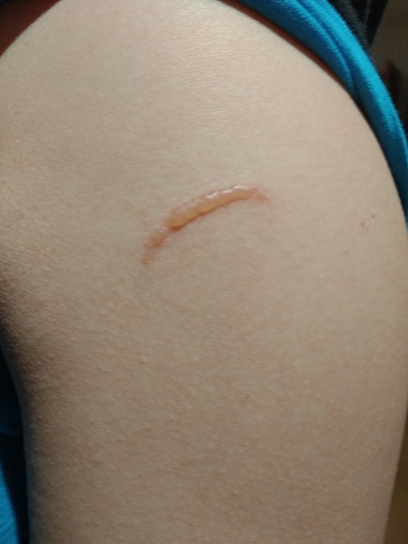 boil appearing on arm near jab site