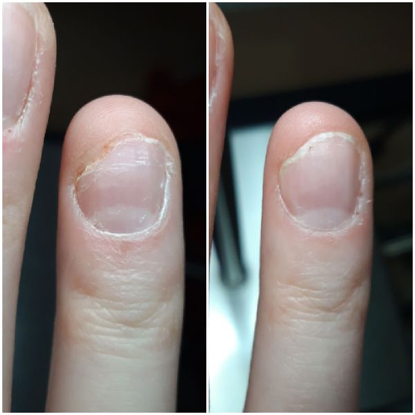 Can't overcome decades-long severe nail-biting: help