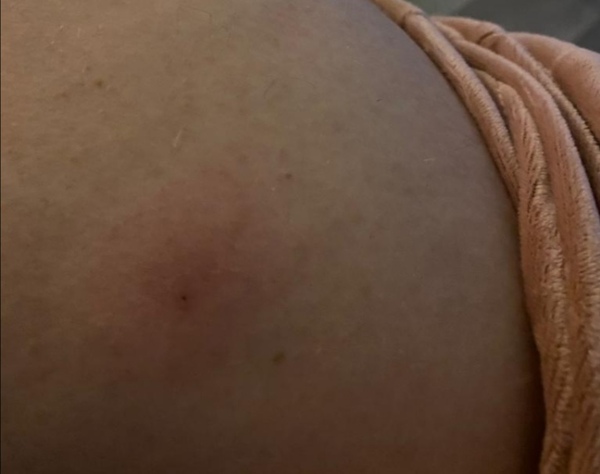 Red area after pfizer vaccine?