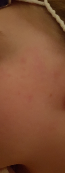 Child has rash- help.