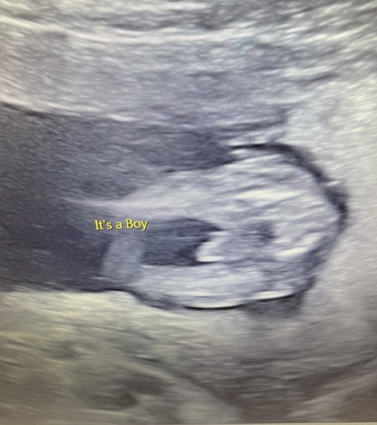 Pregnancy after miscarriage