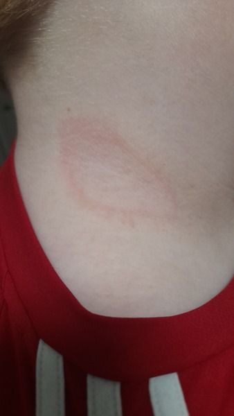 Ringworm Help